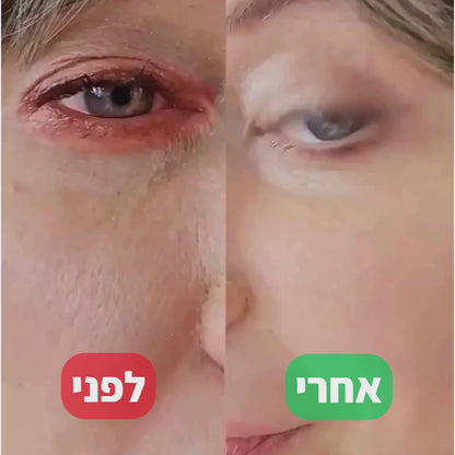 LAVEN Eye Light - הטיפול המוביל בישראל להקלה על יובש ואדמומיות